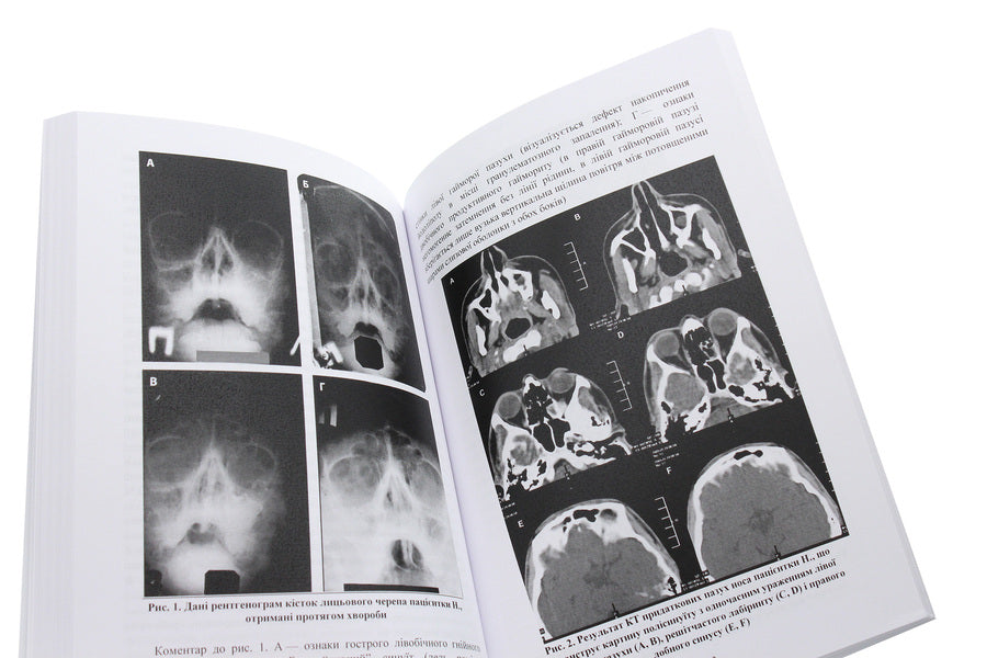 Myeloperoxidase deficiency of phagocytes. Monograph / Дефіцит мієлопероксидази фагоцитів. Монографія Дмитрий Мальцев 978-611-01-1887-3-6