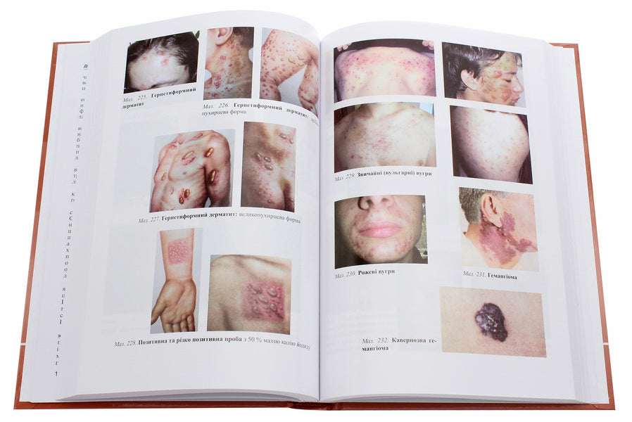 Dermatology and venereology. Textbook / Дерматологія і венерологія. Підручник Виктор Степаненко 978-617-505-811-4-5