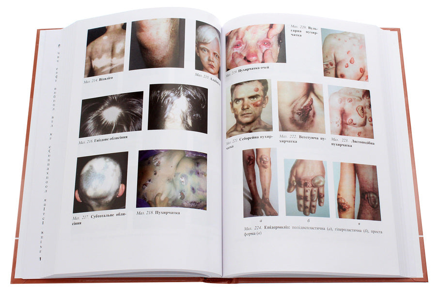 Dermatology and venereology. Textbook / Дерматологія і венерологія. Підручник Виктор Степаненко 978-617-505-811-4-6