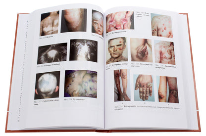 Dermatology and venereology. Textbook / Дерматологія і венерологія. Підручник Виктор Степаненко 978-617-505-811-4-6