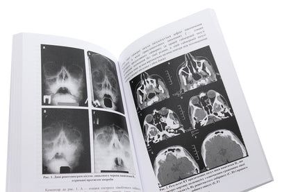Myeloperoxidase deficiency of phagocytes. Monograph / Дефіцит мієлопероксидази фагоцитів. Монографія Дмитрий Мальцев 978-611-01-1887-3-6